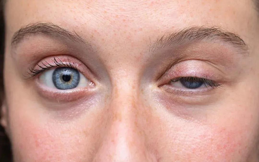 Eyelid Surgery South Africa: Comprehensive Eyelid Care in Cape Town
