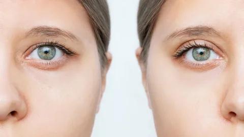 Eyebrow lift Cape Town